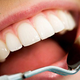 Illustration for article titled Chisel Dental Clinic: Reasons For Cavities And Tooth Decay